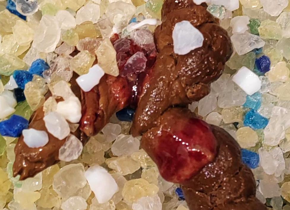 Кал с кровью от чего