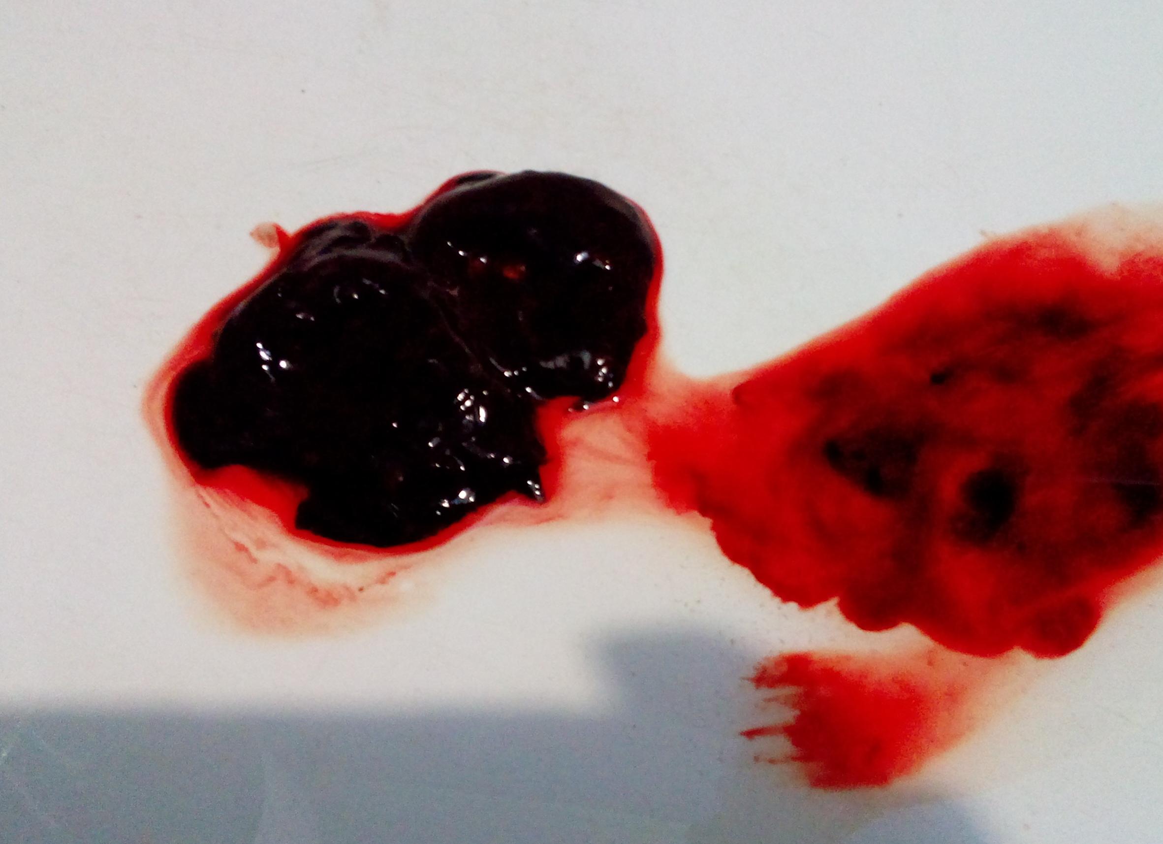 Как выглядит плодное яйцо при выкидыше на раннем сроке фото