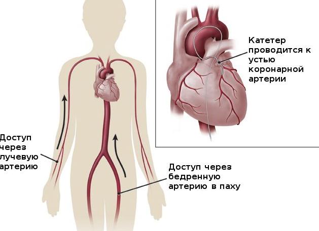 Как делается коронарография Как делается коронарография