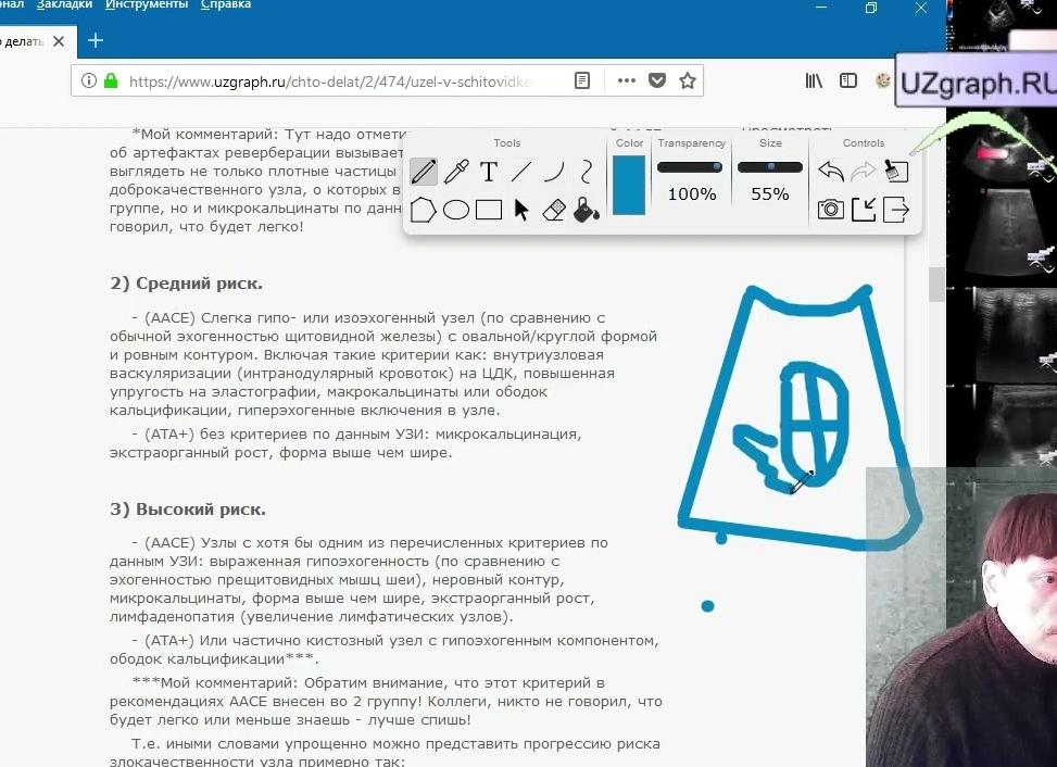 Изоэхогенный узел с гипоэхогенным ободком