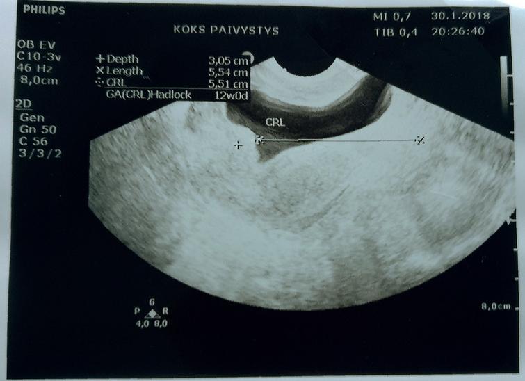 Хгч упал на раннем сроке что делать