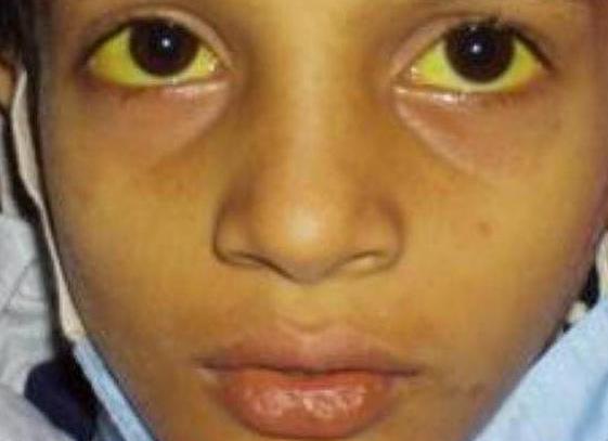 Гепатит с у ребенка