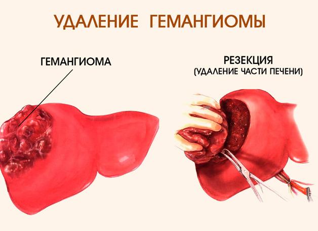 Гемангиома печени фото
