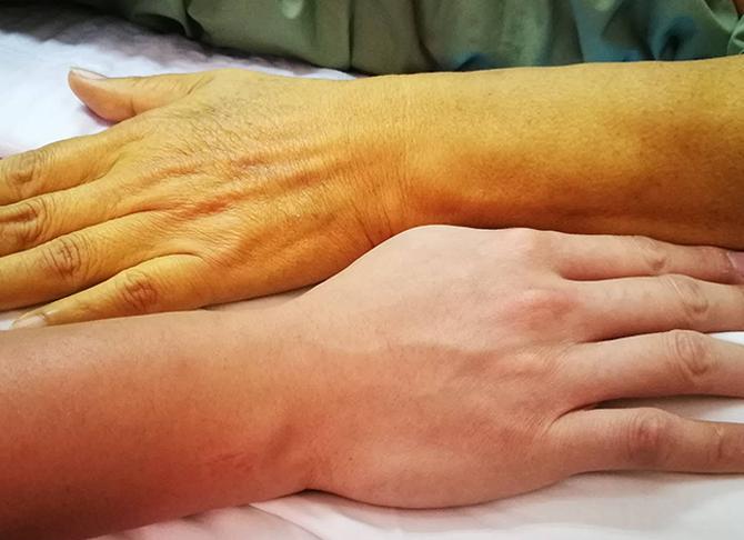 Что нельзя кушать при повышенном билирубине