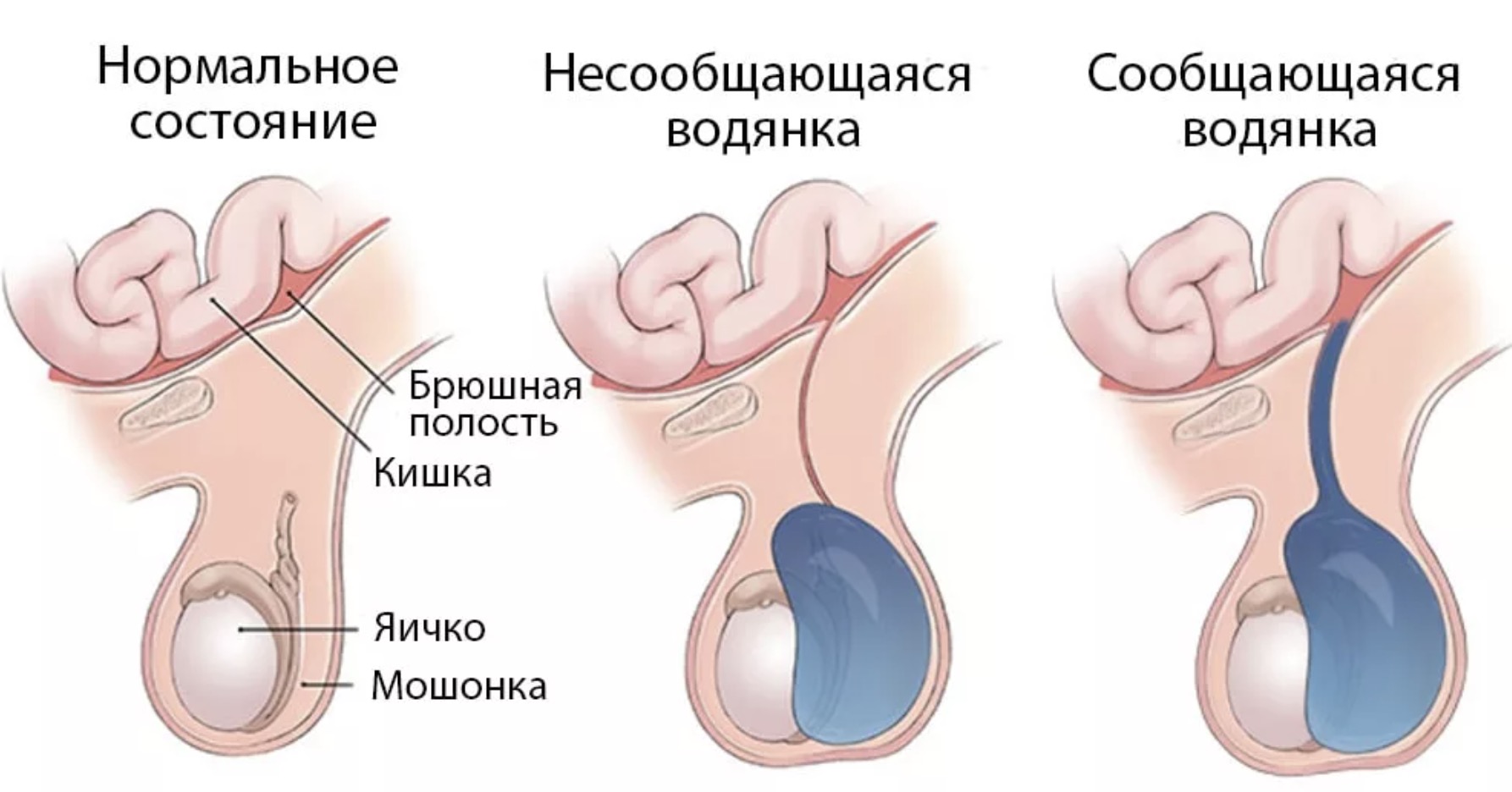 Гидроцеле яичка у ребенка