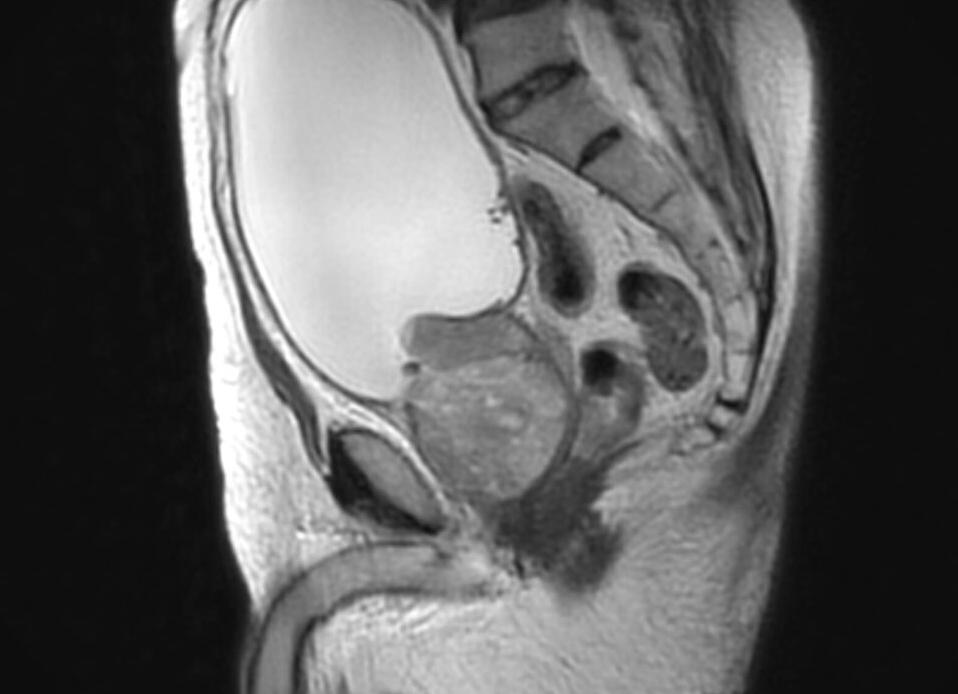 Мрт мочевого пузыря