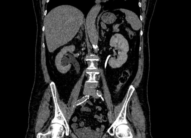 Компьютерная томография почек подготовка
