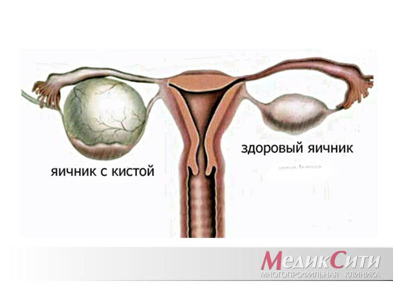 Киста от чего появляется Киста от чего появляется