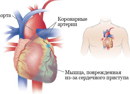 Как проверить коронарные сосуды сердца без коронарографии
