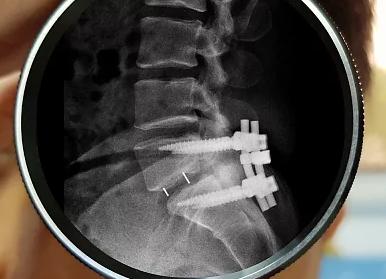 Как лечить стеноз позвоночного канала