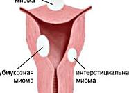 Интерстициальная миома матки