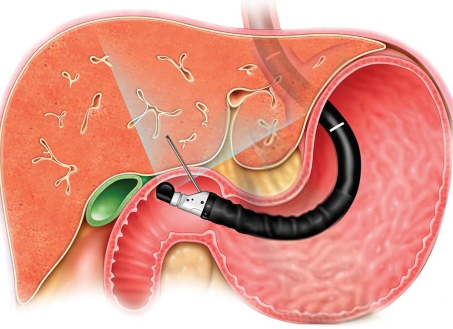 Эндоузи поджелудочной железы