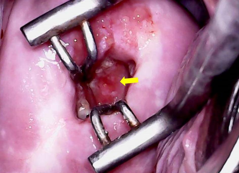 Эндоцервикальные кисты шейки матки