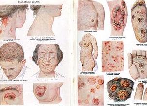 Что такое венерическое заболевание