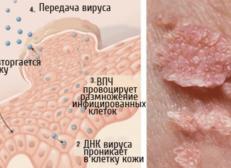 Что такое папилломавирусная инфекция у женщин