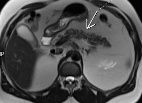 Что показывает мрт поджелудочной железы