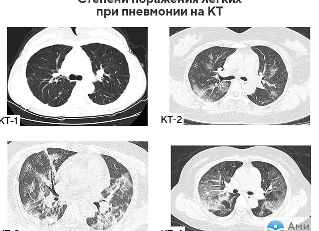 Что показывает компьютерная томография легких