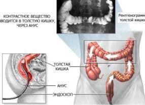 Чем отличается ирригоскопия от колоноскопии