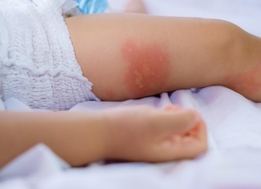 Аллергия на белок яйца