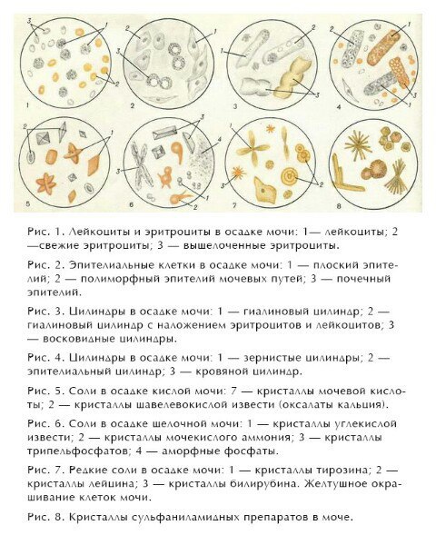 Аморфные фосфаты в моче что это значит