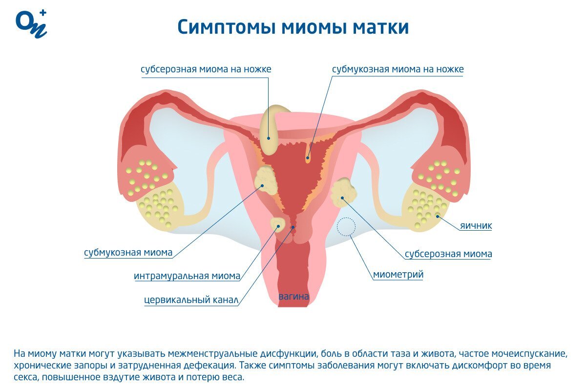 Как выглядит миома матки