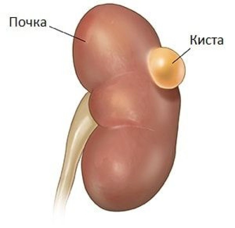 Киста правой почки