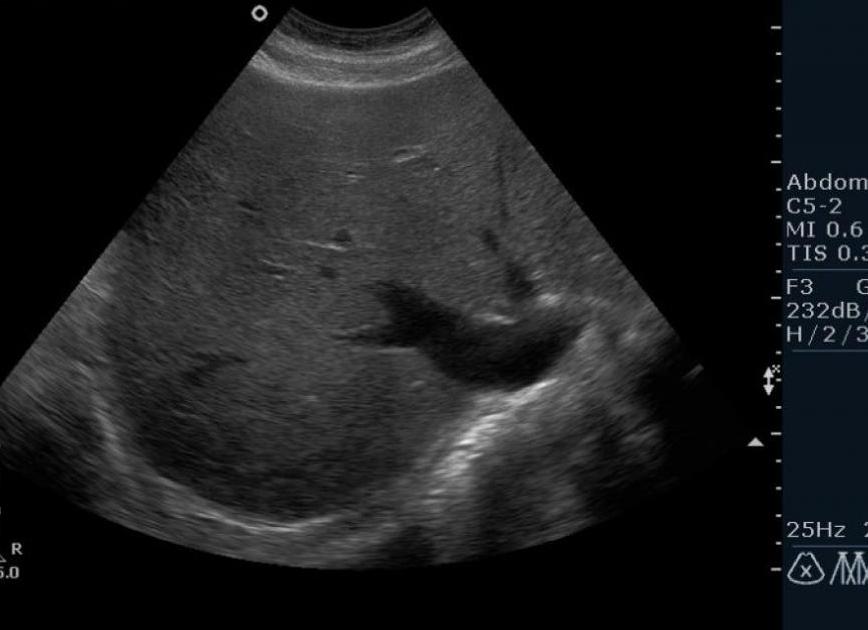 Может ли показать узи печени цирроз