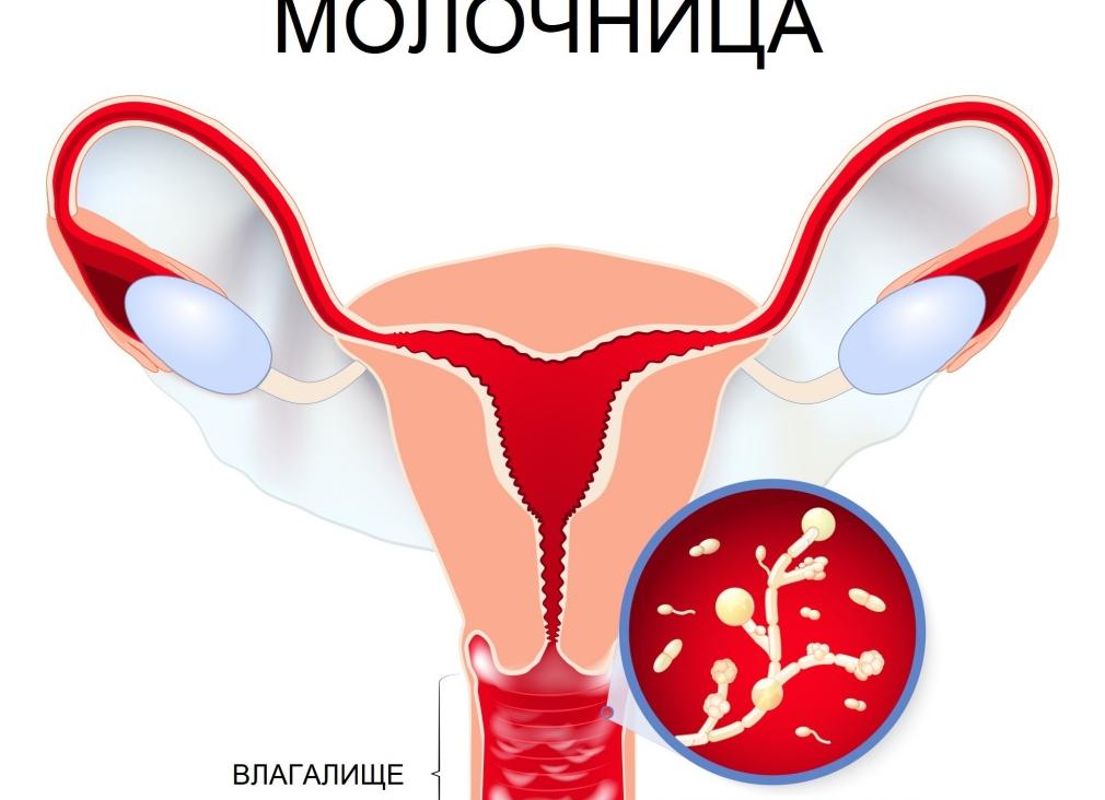 Молочница от чего возникает у мужчин