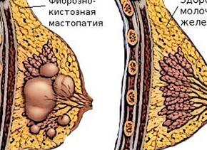 Мастопатия фиброзно кистозная это
