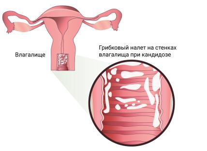 Кислый запах выделений