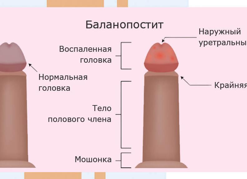 Кандидозный баланопостит фото у мужчин