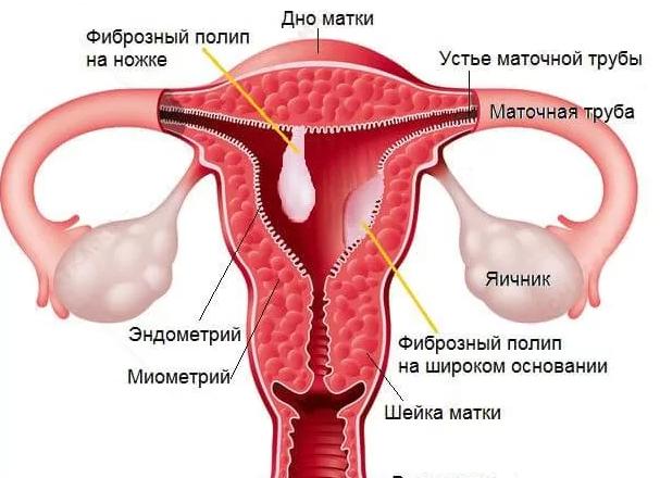 Фиброзный полип эндометрия что это такое