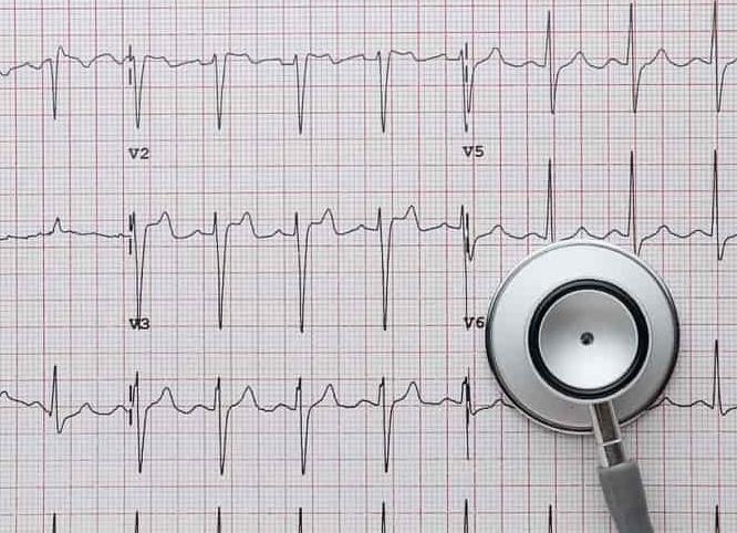 Электрокардиограмма сердца расшифровка