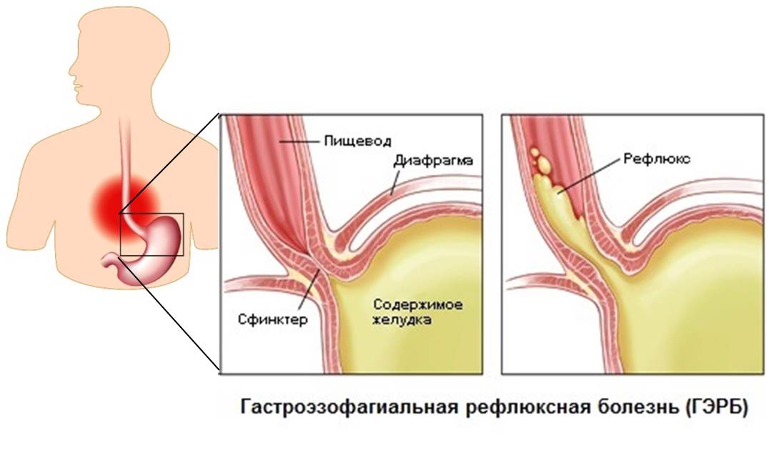 Гэрб что это