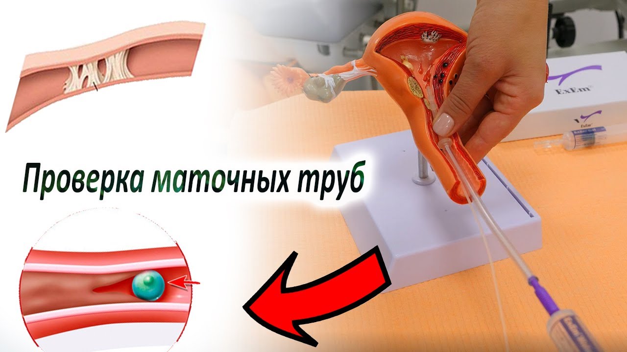 Как смотрят проходимость маточных труб