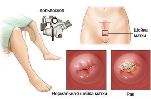 Когда делать кольпоскопию до или после месячных