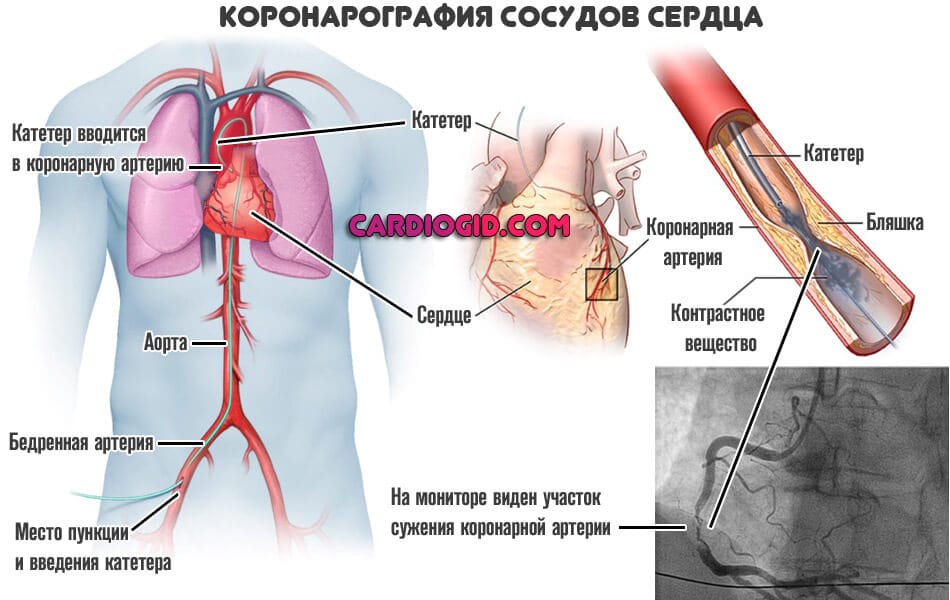 Коронарография сосудов сердца что это последствия
