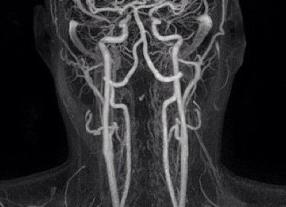 Мрт сосудов позвоночника