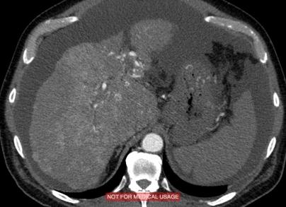 Мрт цирроз печени