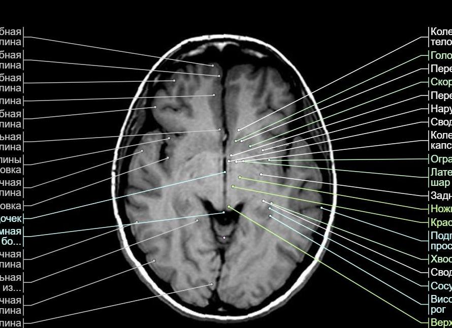 Мрт анатомия головного мозга Мрт анатомия головного мозга
