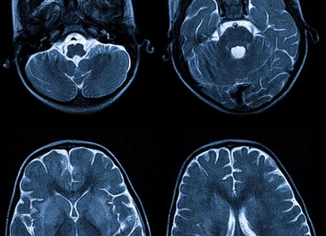 Может ли болеть голова после мрт