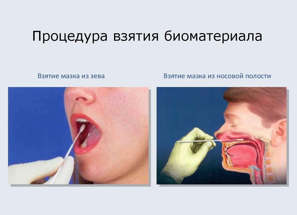 Мазок из гортани