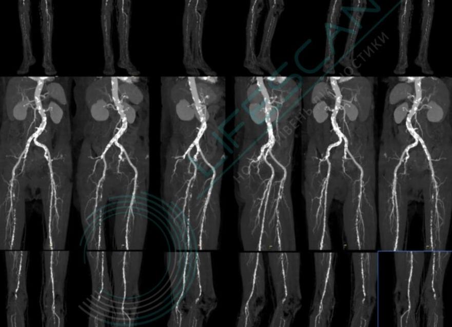 Кт сосудов нижних конечностей