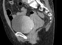 Кт мочевого пузыря