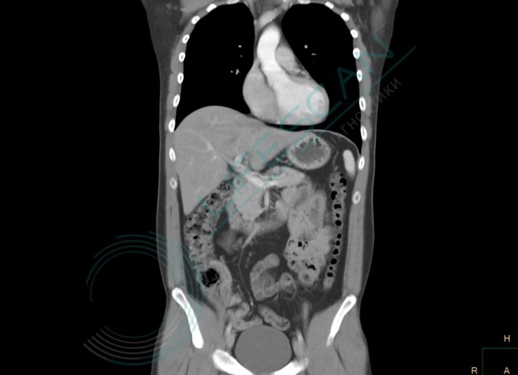 Кт грудной клетки и брюшной полости с контрастом Кт грудной клетки и брюшной полости с контрастом