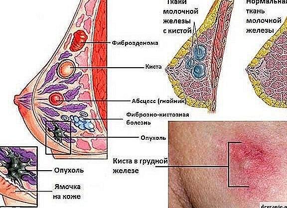 Киста в грудных железах