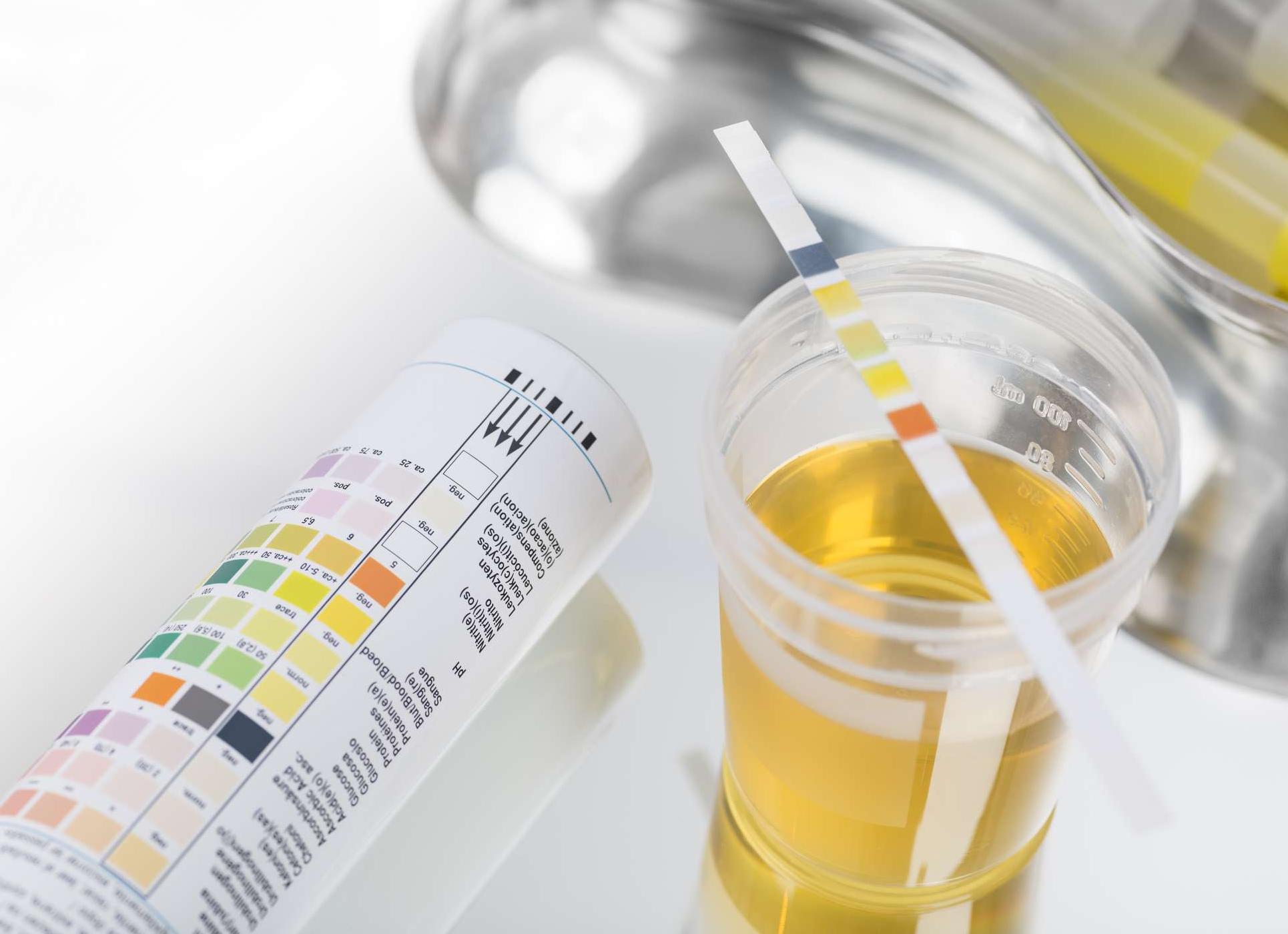 Как в анализе мочи обозначается белок