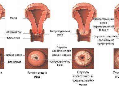 Изменения шейки матки
