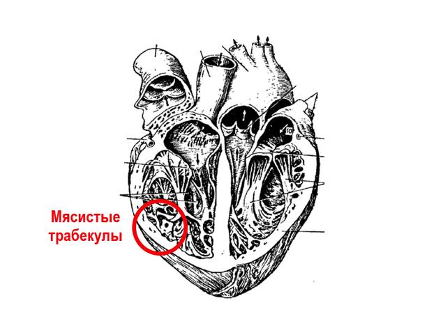 Диагональная трабекула левого желудочка у ребенка
