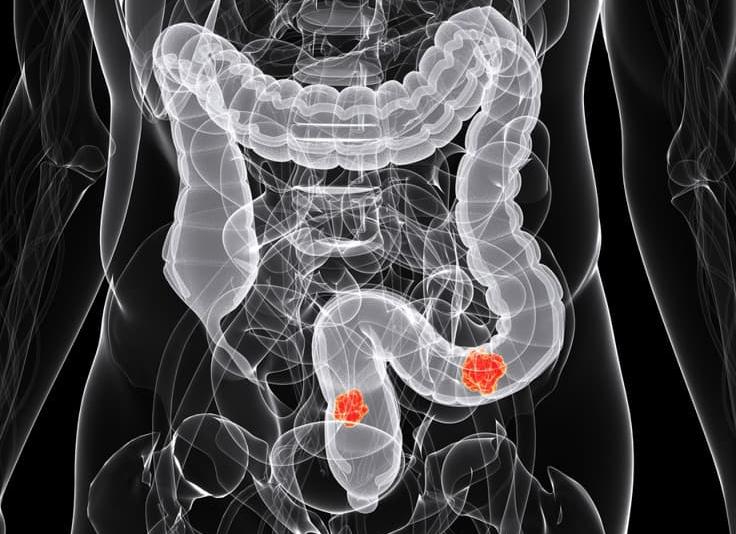 Что лучше колоноскопия или ирригоскопия кишечника